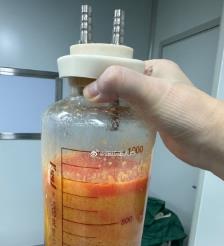 昌吉水动力吸脂手术要做多久？